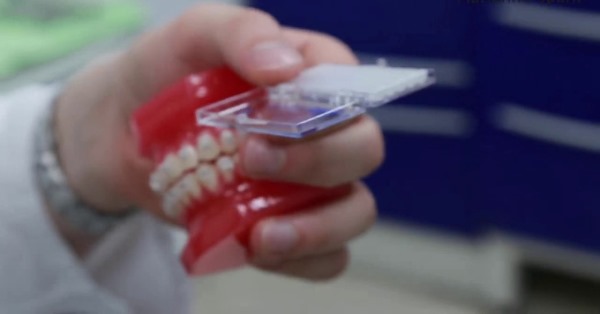 Ортодонтический силикон для брекетов