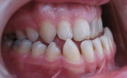 Оральное положение зубов лечение