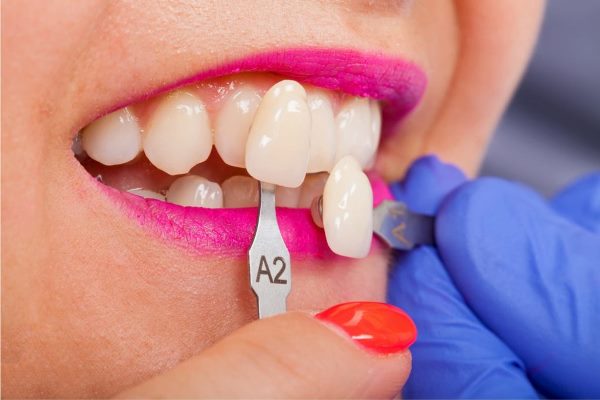 Об эффективности исправления прикуса винирами в стоматологии