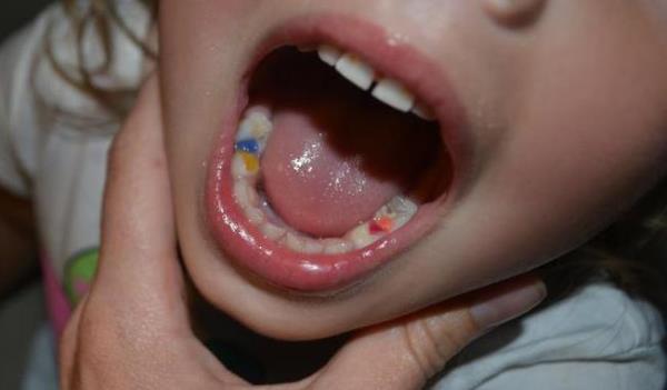 Композитные материалы применяемые в детской стоматологии