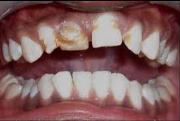 Зубы Тернера лечение