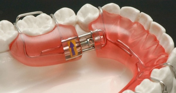 Элементы опоры и фиксации съемных ортодонтических аппаратов