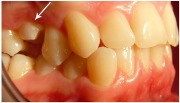 Импактные зубы лечение