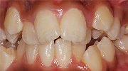 Скученность зубов лечение