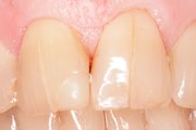 Трещины на эмали зубов что делать