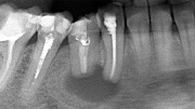 Радикулярная киста зуба лечение