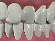 Трещины на эмали зубов