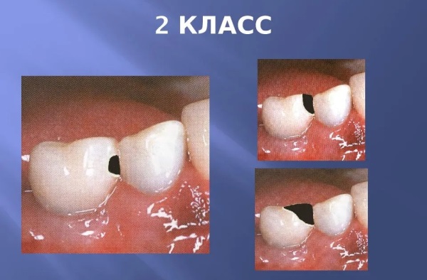 Реставрация жевательной поверхности зубов