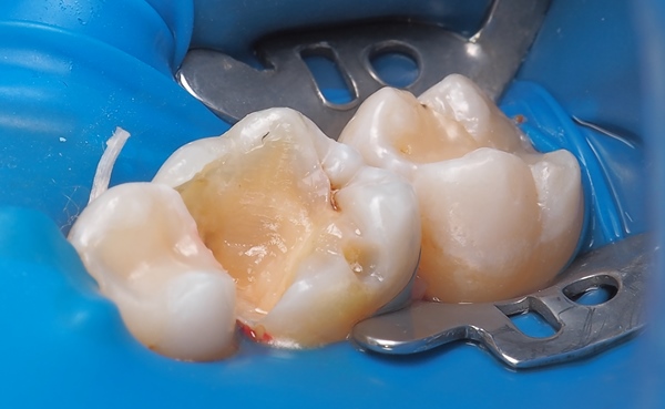 Методики восстановления жевательной группы зубов