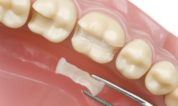 Какой протез зубной лучше съемный или несъемный