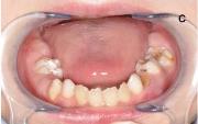 Бычьи зубы лечение