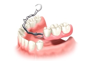 Зубные протезы при частичном отсутствии зубов