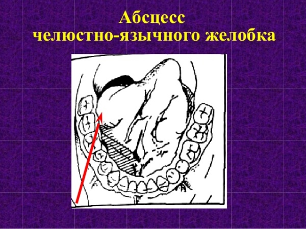 Абсцесс локализованные в полости рта латынь