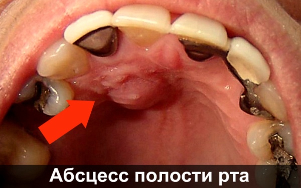 Абсцессы и флегмоны дна полости рта