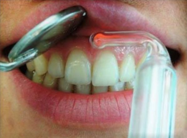Как проводится вакуум терапия в стоматологии