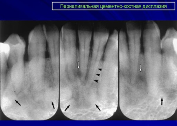 Фиброзная дисплазия нижней челюсти