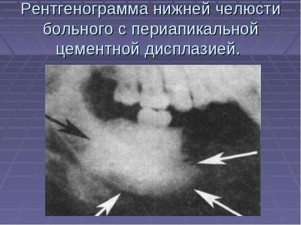 Фиброзная дисплазия верхней челюсти