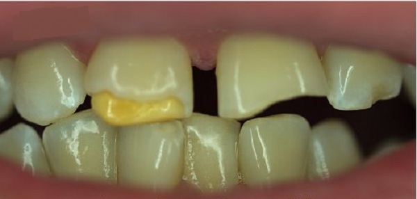 Аплазия эмали зубов
