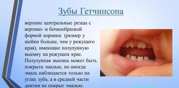 Зубы гетчинсона это