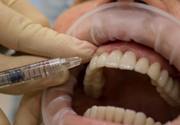 Применение гиалуроновой кислоты в стоматологии