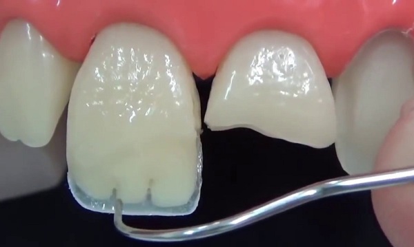 Нанесение пломбы на зуб