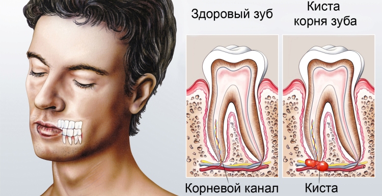 киста зуба и ее симптомы