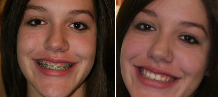 брекеты до и после фото с примерами лечения