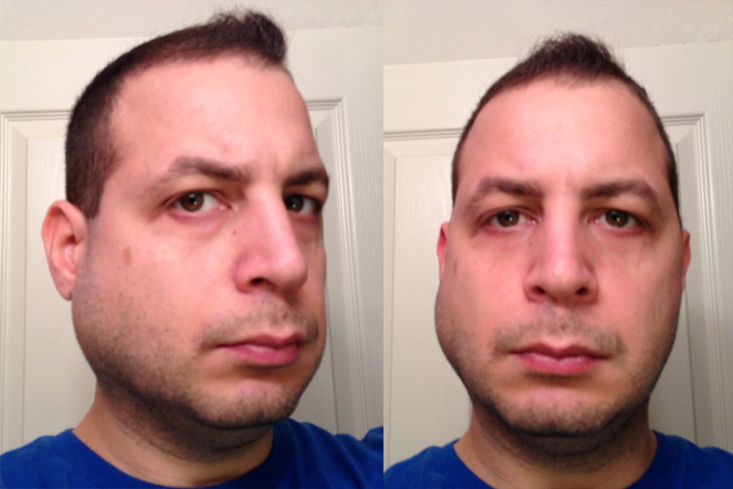 Красный лоб у мужчины. Перелом носа фото до и после.