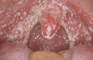 Лечение стоматита в домашних условиях на щеке thumbnail