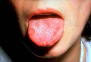 Стоматит на щеке лечение в домашних условиях thumbnail