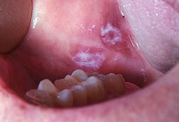 Лейкоплакия полости рта лечение в домашних thumbnail