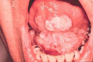 возможные виды лейкоплакии полости рта