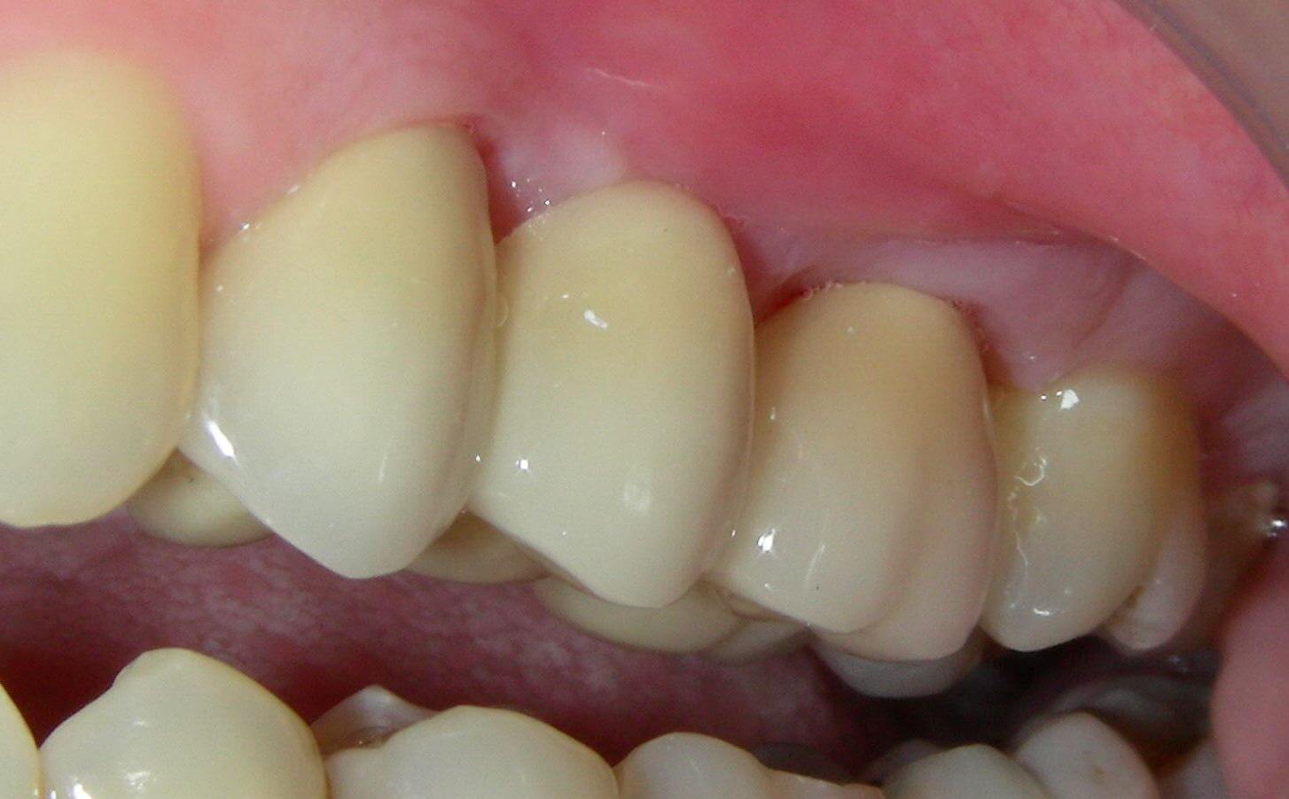 металлокерамические зубы цены для пациентов
