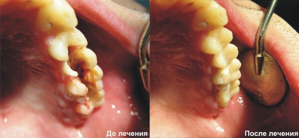 Лечение 6 зуба фото thumbnail