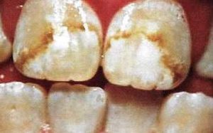 Белые полосы на зубах лечение thumbnail