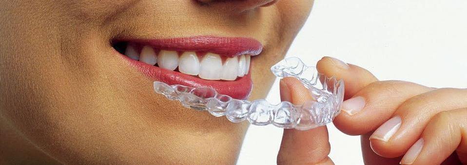 капы для выравнивания зубов у человека
