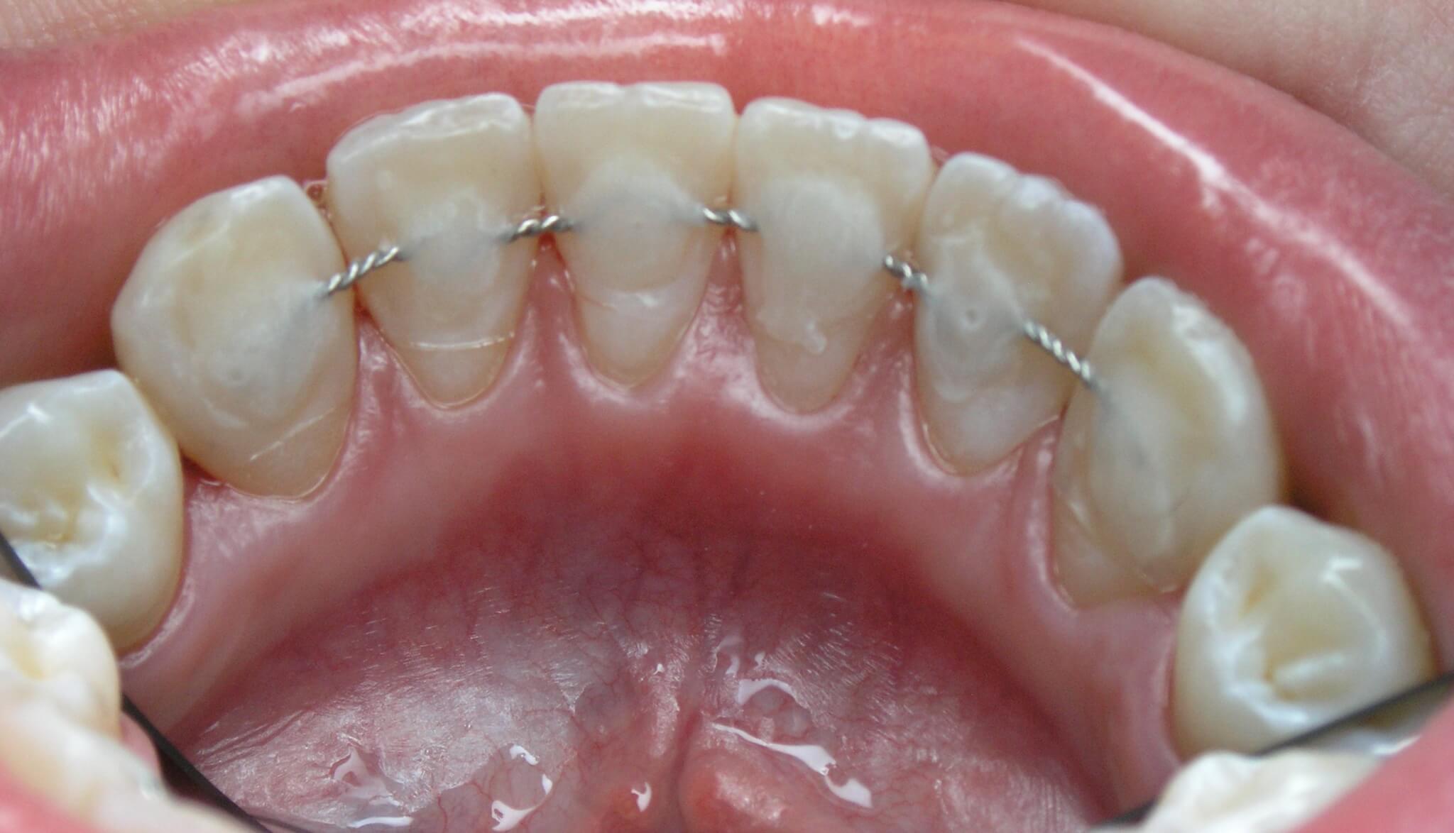 шинирование зубов фотографии до операции и после