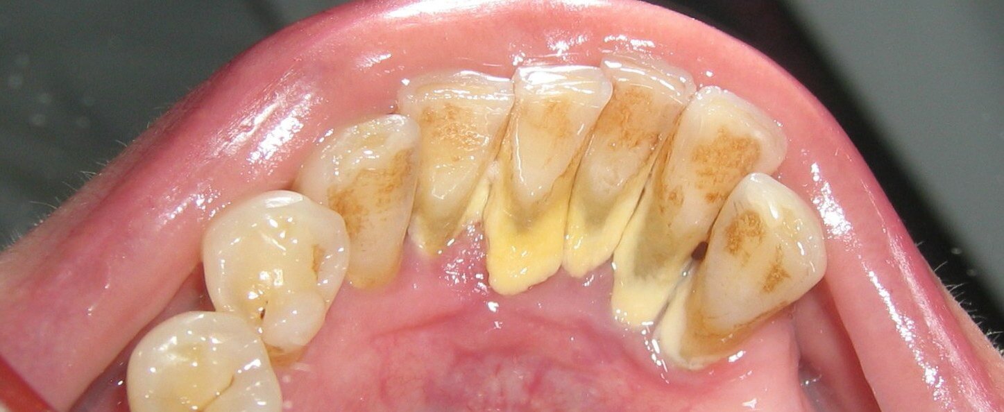 основные причины зубного камня у людей