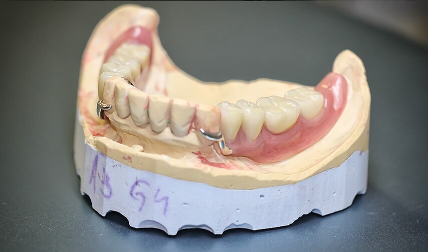 фото бюгельного зубного протеза на нижнюю челюсть
