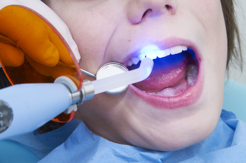 световые пломбы на передних зубах у пациента