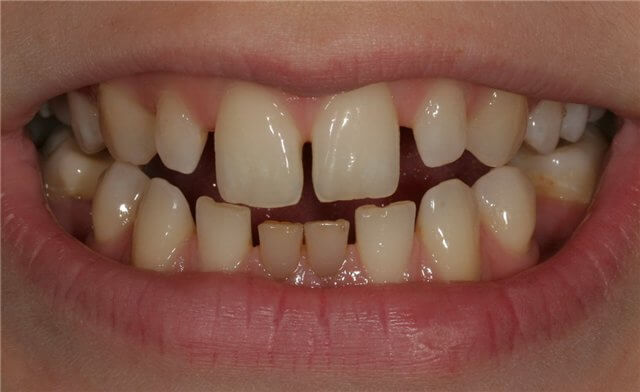Расходятся зубы причина лечение thumbnail