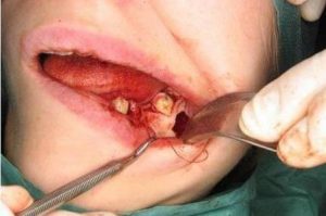 проблемы после операции резекции верхушки корня зуба