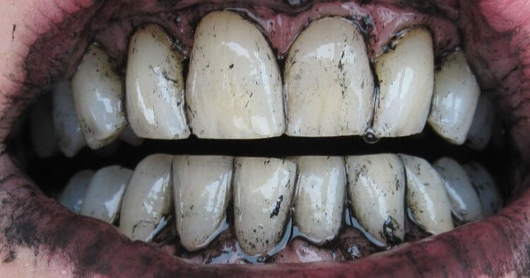отбеливание зубов с использованием активированного угля