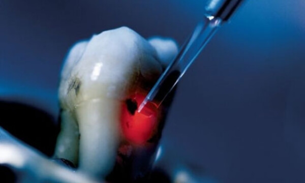 Терапия гранулемы зуба с помощью лазера