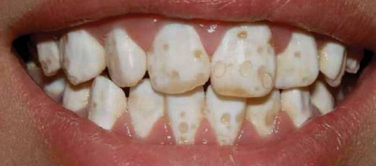 гипоплазия эмали зубов и способы борьбы с ней