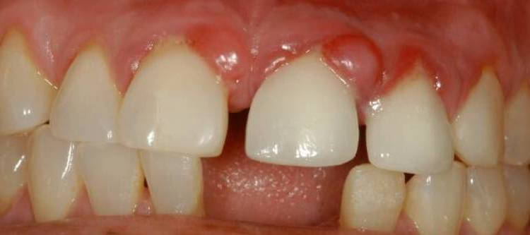 гранулема зуба - способы лечения дома и в клинике