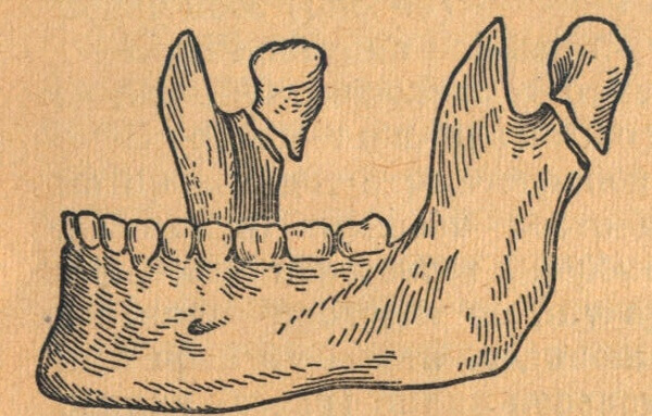 Протезирование зубов после перелома челюсти thumbnail