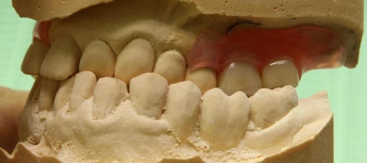 патология зубов - перекрестный прикус