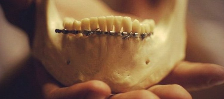 Перелом челюсти со смещением пластины thumbnail