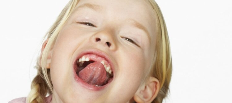 подрезание уздечки под языком у детей больно ли это